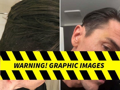 0625-Tom-Sandoval-Injuries-PRIMARY