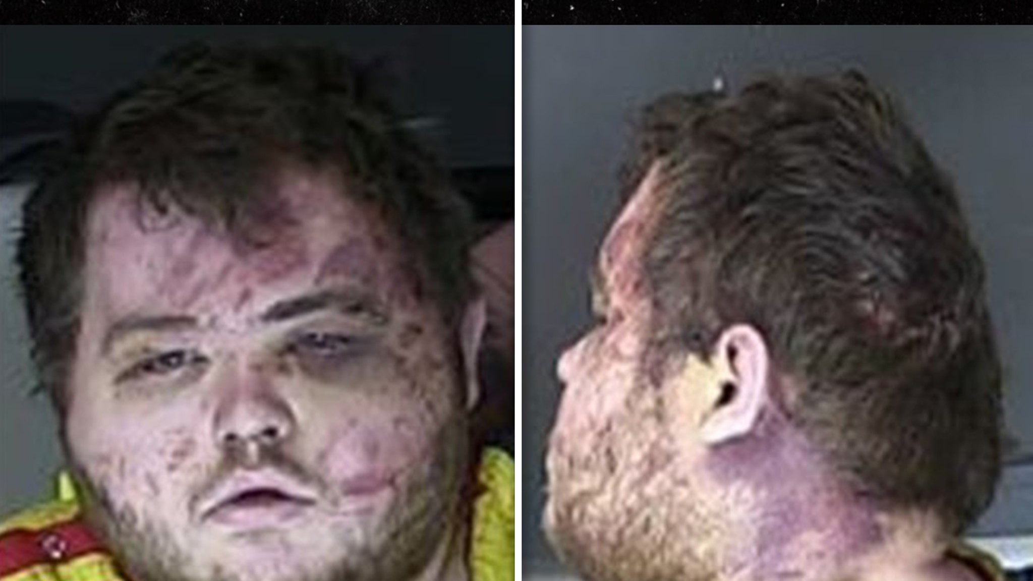 Photo of Colorado shooting suspect shows significant bruising and swelling