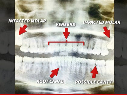 0325-miley-cyrus-teeth-INSTAGRAM-01