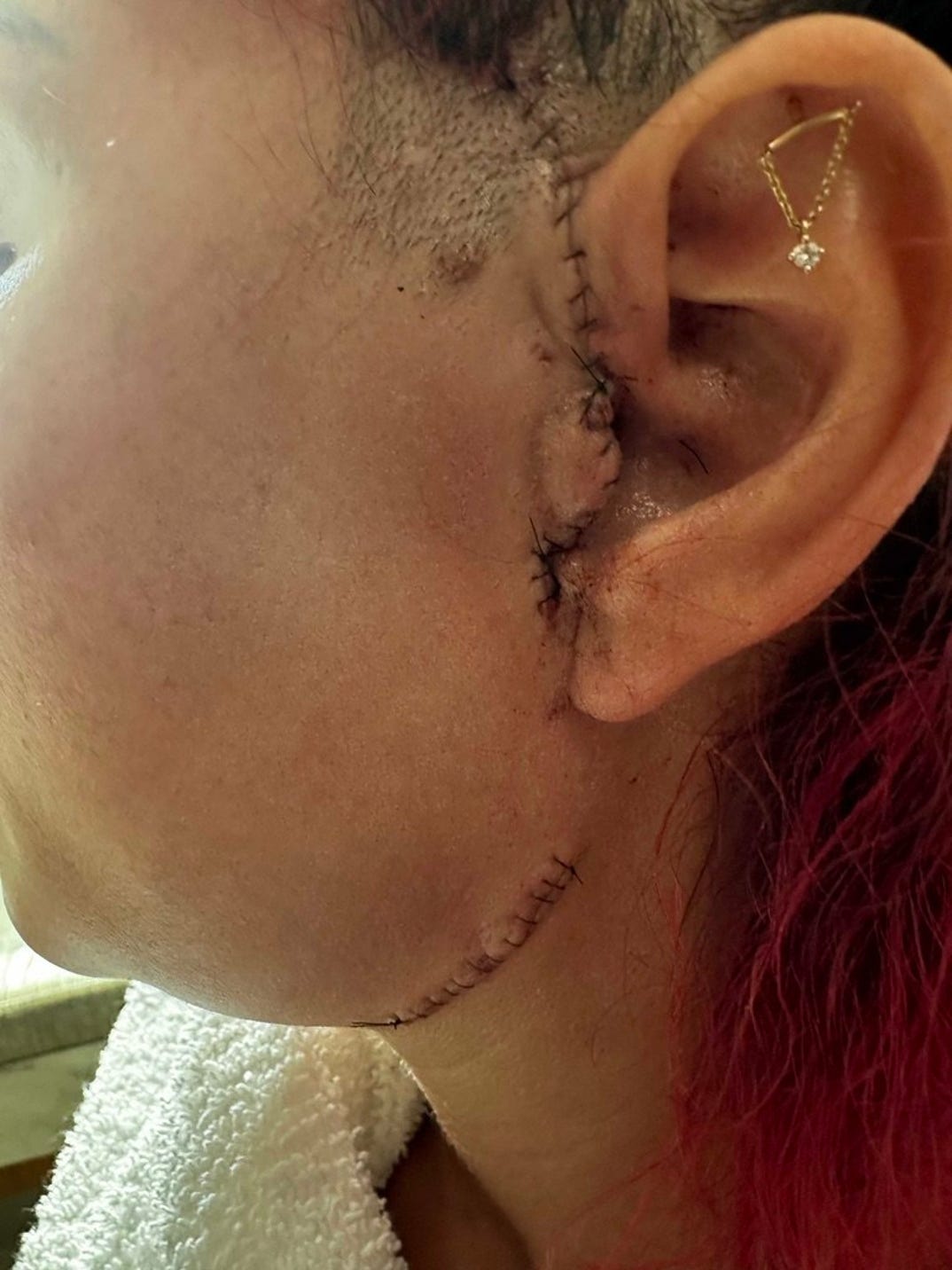 Farrah Abraham Post Op Photos 4