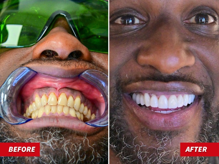 taylor swift teeth before veneers