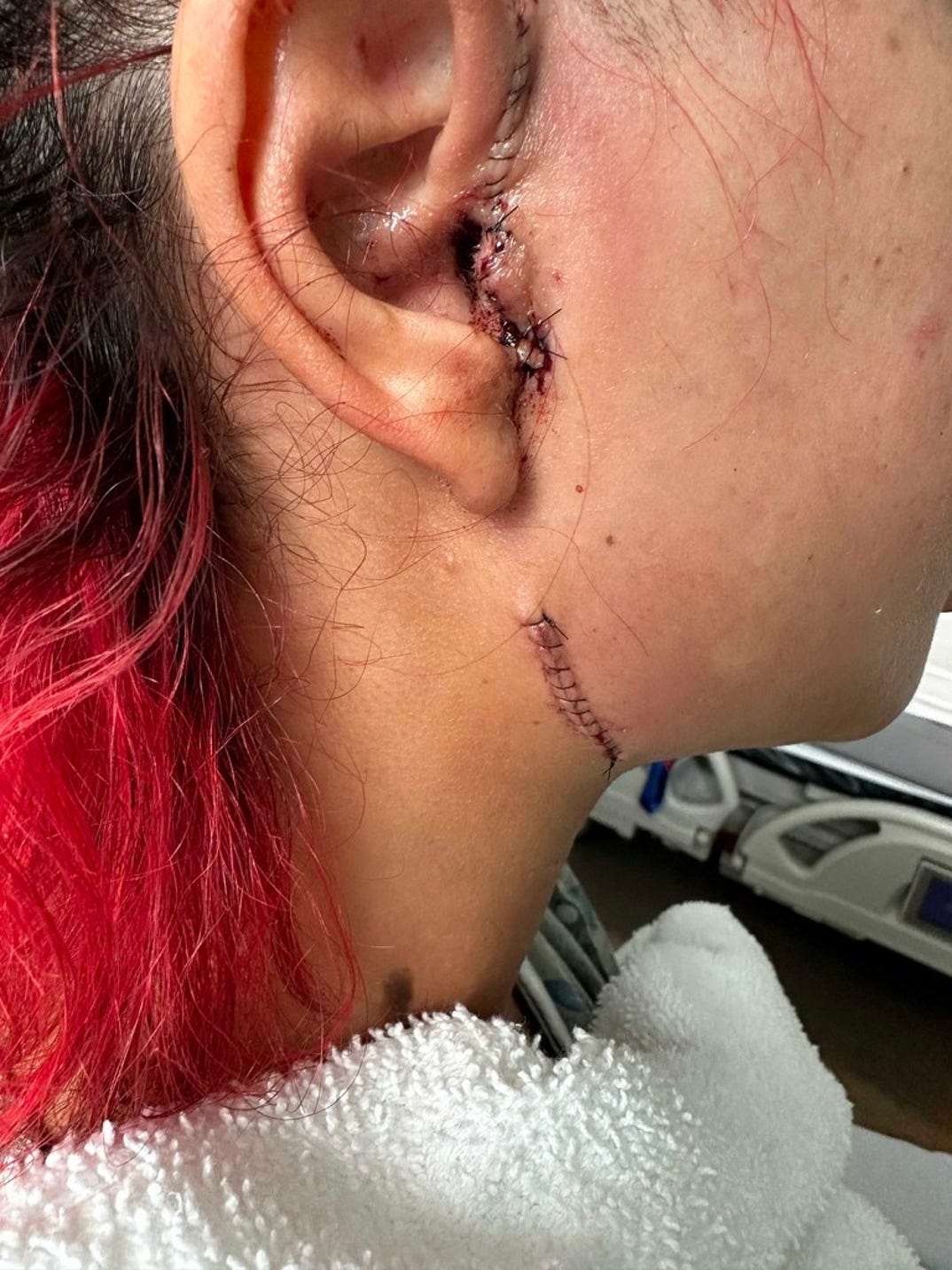 Farrah Abraham Post Op Photos 3