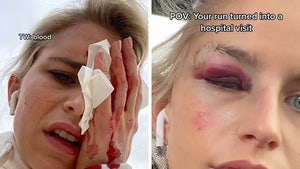 Paris Fashion Week Model Suffers Bloody Injury After Running Into A Pole