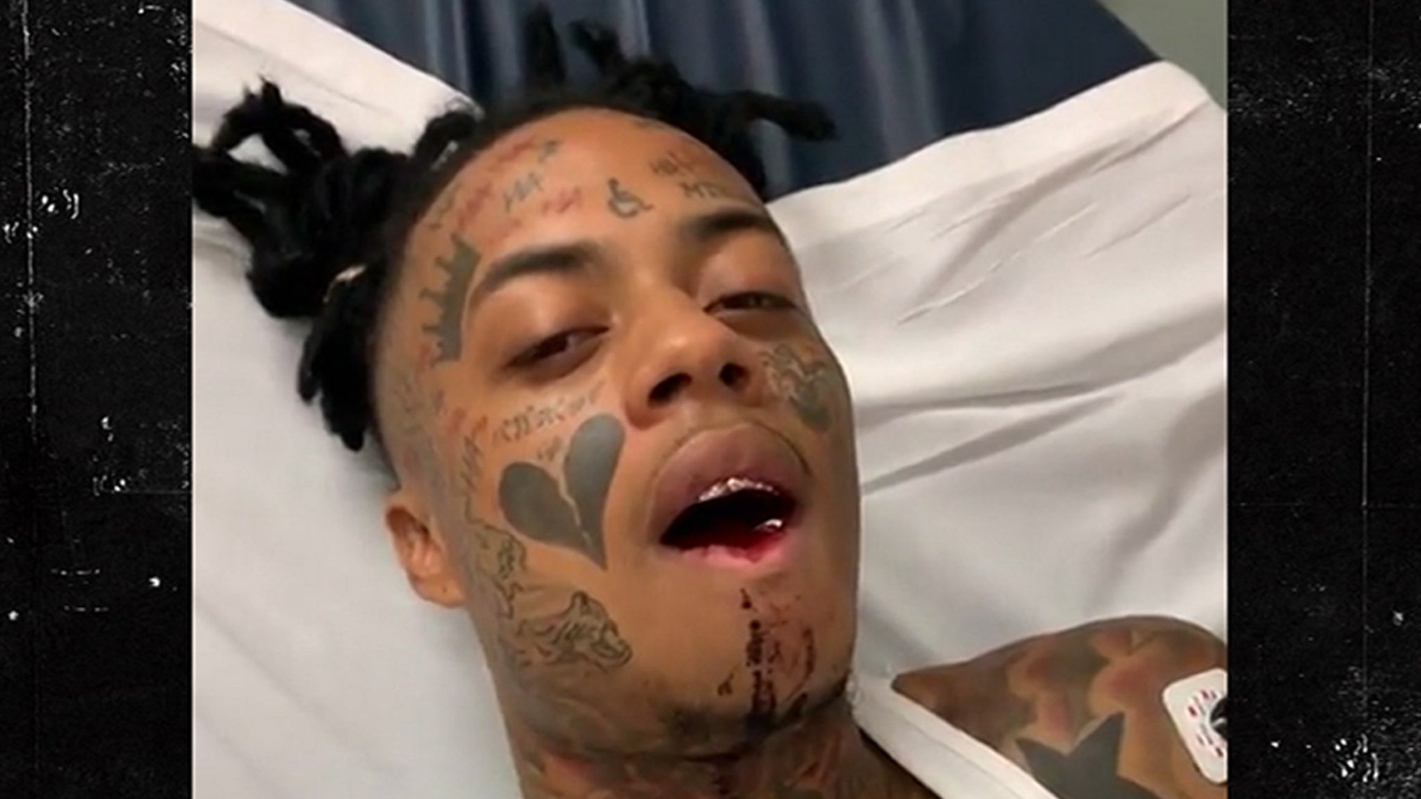 Rapper Boonk Recovers From Broken Jaw Surgery After Getting Punched 