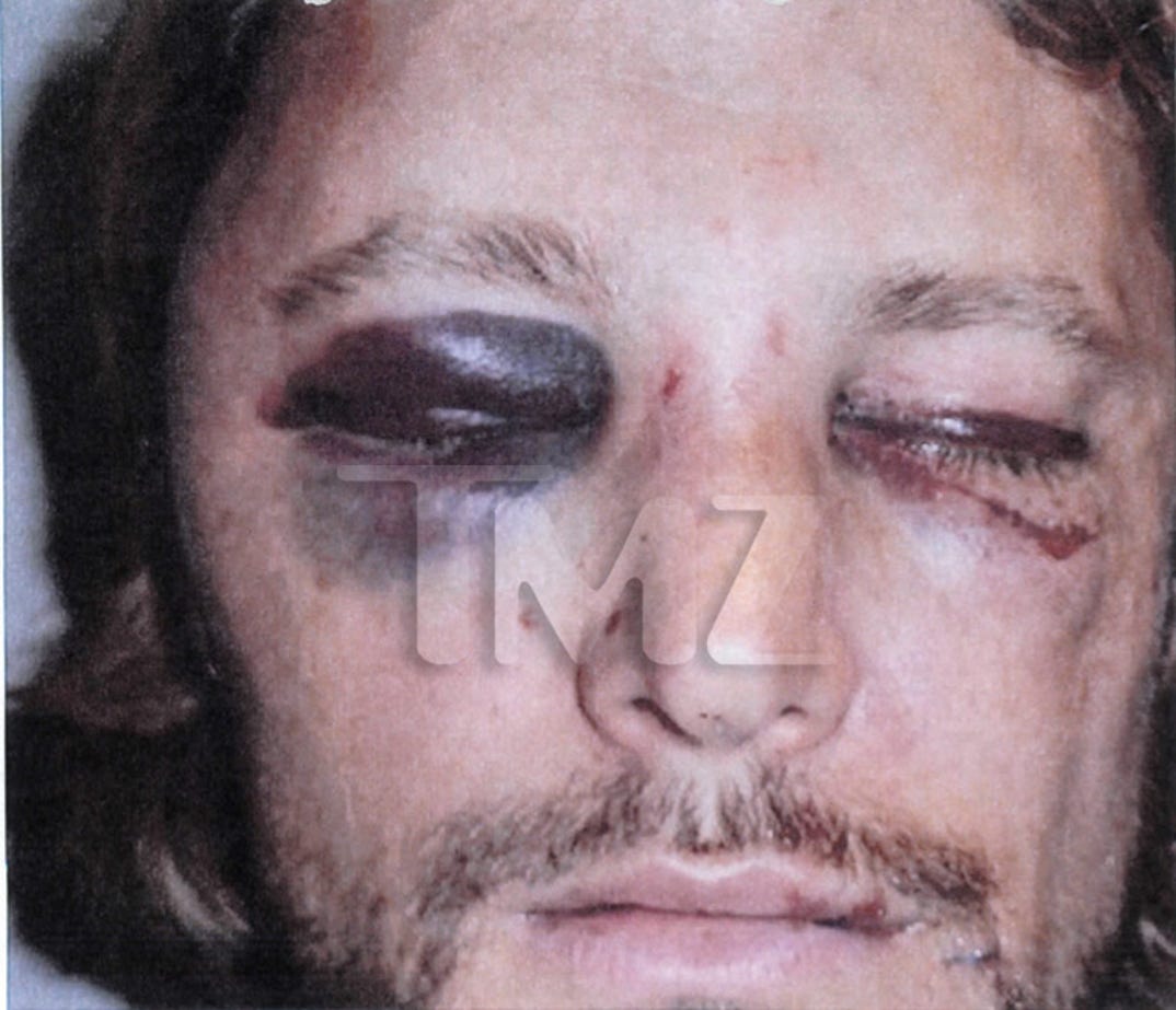 gabriel_aubry_fight_injuries_01