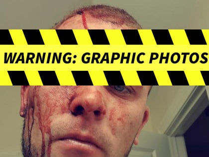 0701-Kyle-Hadala-Alleged-Injuries-graphic-photos-05