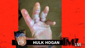 Hulk Hogan -- Hand Burning Accident Was 'Dumbest Thing I've Ever Done'