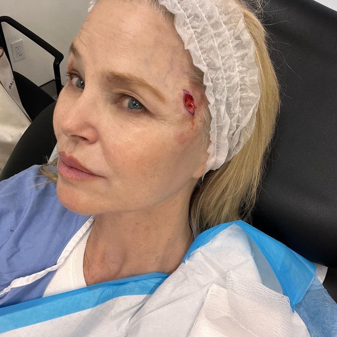 Christie Brinkley Skin Cancer Photos